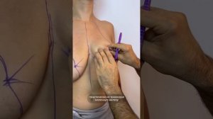 ВЫПОЛНЕНА УМЕНЬШАЮЩАЯ МАММОПЛАСТИКА ПРИ ГИПЕРМАСТИИ. Доктор Карапетян