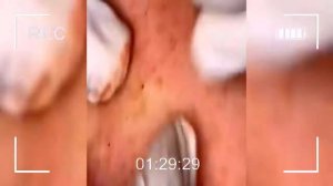 лучшее удаление черных точек#9