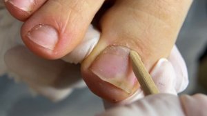 Онихолизис на большом пальце #педикюр #онихолизис #nails