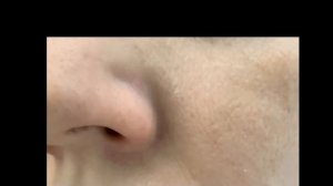 Некроз после инъекции филлера.