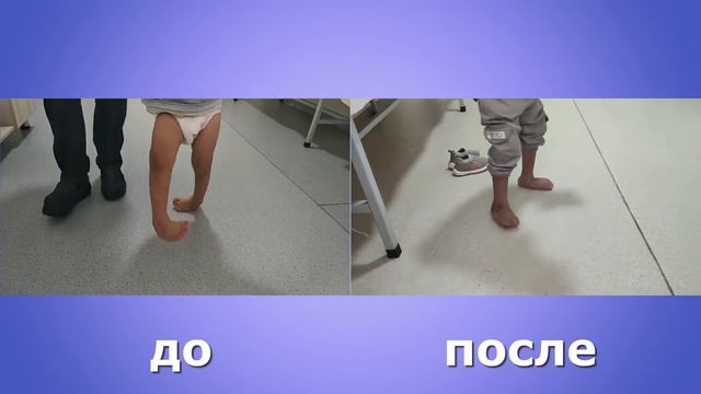 ДВУСТОРОННЯЯ КОСОЛАПОСТЬ - Мальчик 2019 г.р.