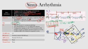 34.Sinus Arrhythmia