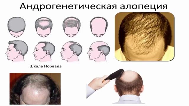 Причины выпадения волос. 8 болезней вызывающих облысе?