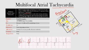 42.Multifocal Atrial Tachycardia