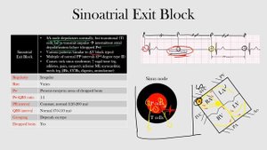 38.Sinoatrial Exit Block