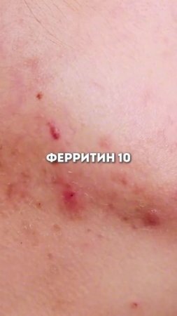Ферритин 10 vs. Ферритин 40