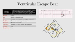 54.Ventricular Escape Beat
