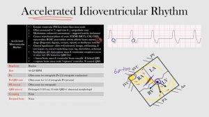 56.Accelerated Idioventricular Rhythm