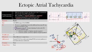 40.Ectopic Atrial Tachycardia
