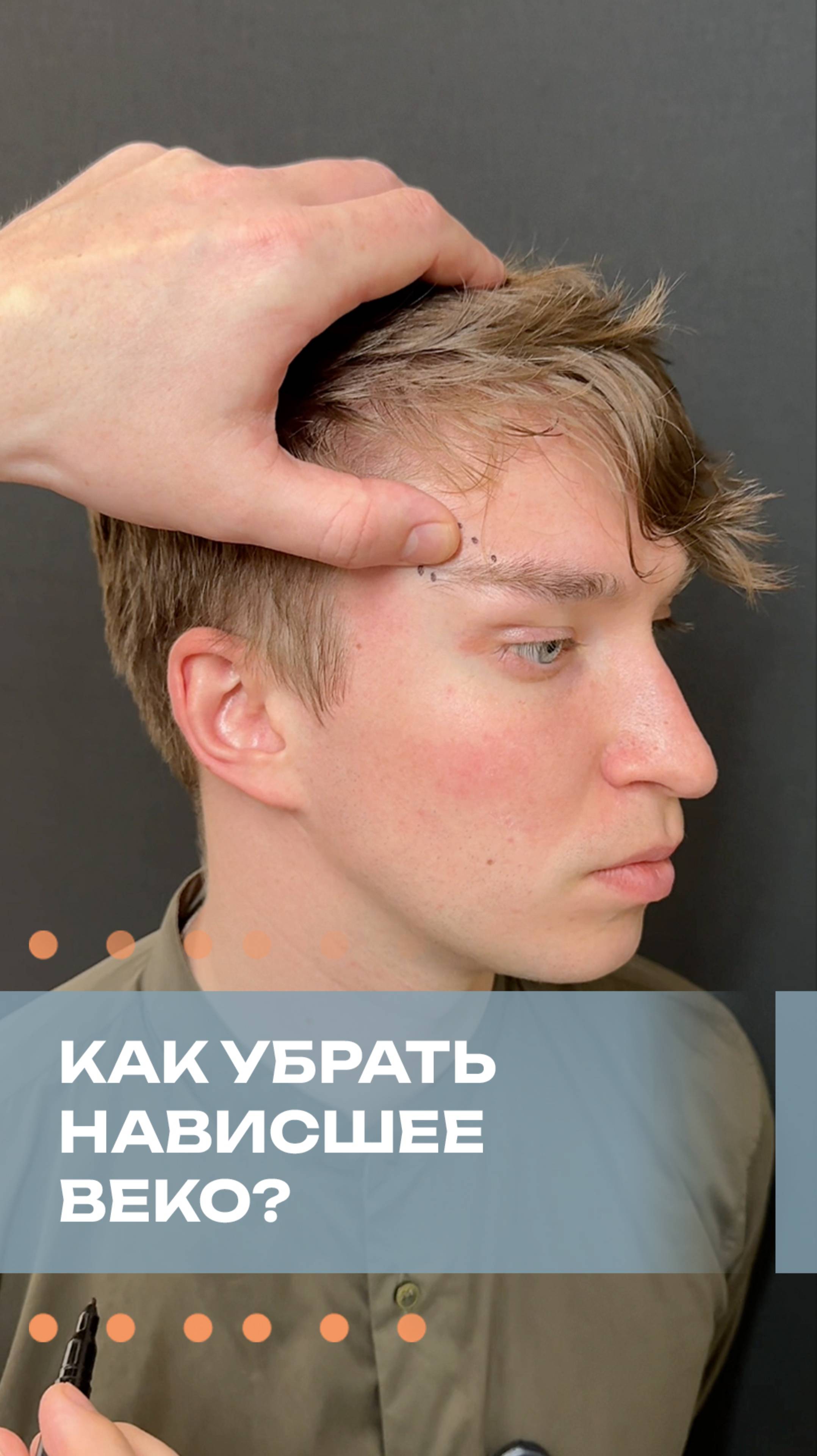 Как убрать нависшее веко?