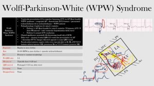 50.Wolff-Parkinson-White (WPW) Syndrome