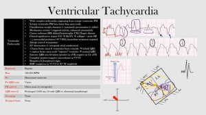59.Ventricular Tachycardia