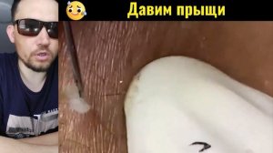 МНОЖЕСТВО КОМЕДОНОВ И САЛЬНЫХ ТОЧЕК #26