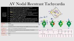 49.AV Nodal Reentrant Tachycardia
