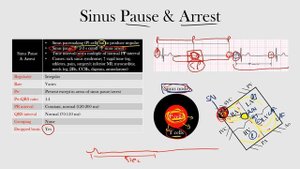 37.Sinus Pause & Arrest