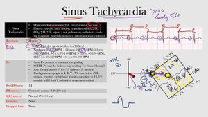 36.Sinus Tachycardia
