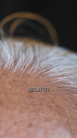 Пересадка волос #podcast #интервью