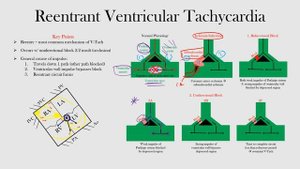 60.Reentrant Ventricular Tachycardia