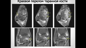 МРТ в диагностики основных повреждений голеностопного сустава