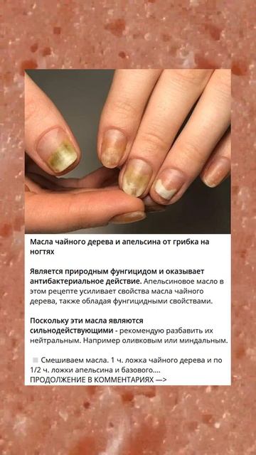 Масла чайного дерева и апельсина от грибка на ногтях смотреть онлайн