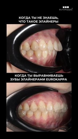 Начни свой путь к ровным зубам вместе с элайнерами #eurokappa #еврокаппа