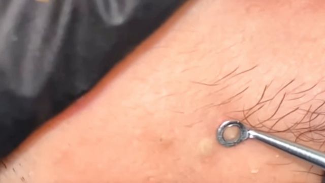 Убираем Прыщи и черные точки на лице