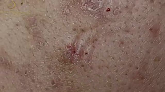 Видео 7. Очистка лица от угрей и акне. Выдавливание прыщей. Удаление черных точек и комедонов.