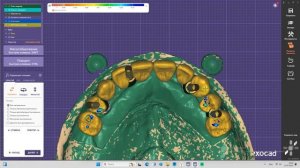 All on 4 + multi unit Exocad