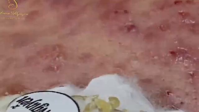 Видео 5. Очистка лица от угрей и акне. Выдавливание прыщей. Удаление черных точек и комедонов.