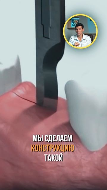 Импланты
