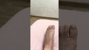 Перелом пятки со смещением. Часть 8. Нога без гипса