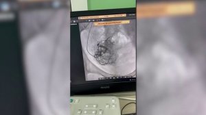 Эмболизация маточных артерий. Один из методов лечения миомы матки.