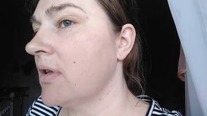 Электроэпиляция лица. 6 курс. Прошло 11 дней.