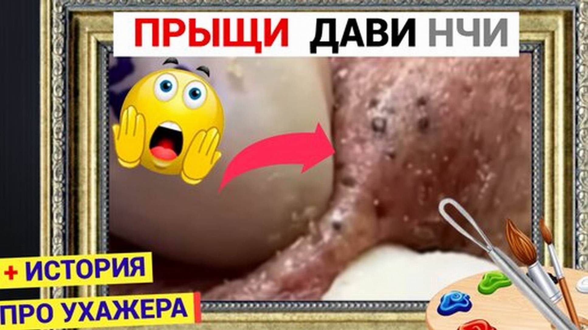 Прыщи 058 Вызов для Косметолога - очень СТАРЫЕ Черные Точки и Комедоны подъехали. Друг моего мужа ок