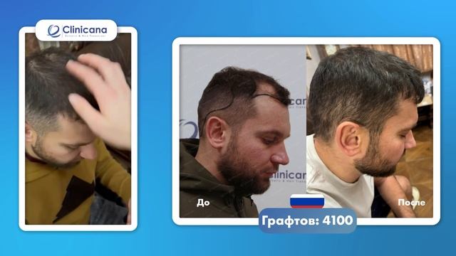 Результат за восемь месяцев в Clinicana смотреть онлайн