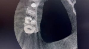 снимок с Planmeca был открыт в ПО MyDentViewer, обнаружен 4 канал