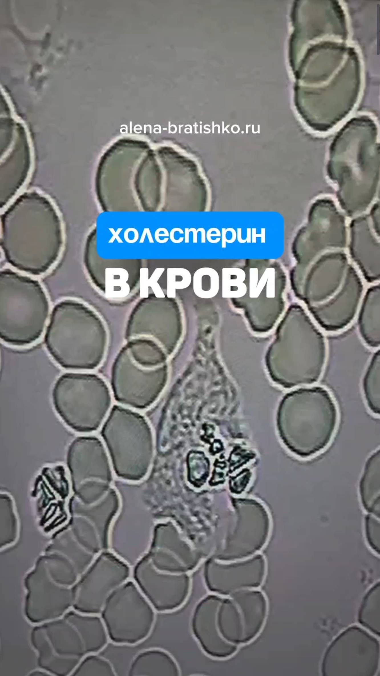 Холестерин в крови. Алена Братишко