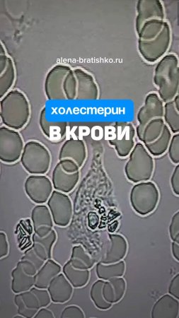 Холестерин в крови. Алена Братишко