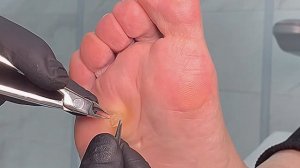 Как глубоко корешок стержневой мозоли может утопать в