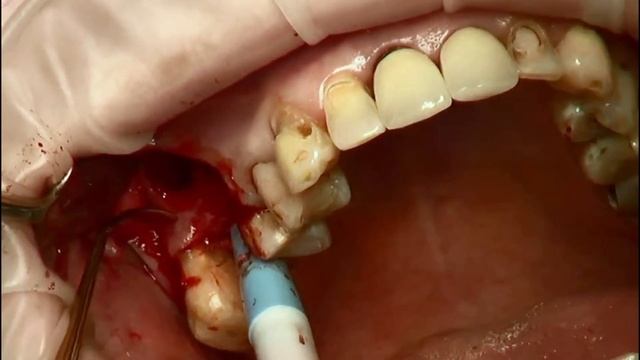 Открытый синус-лифтинг. Операция. Коллагеновый матр смотреть онлайн