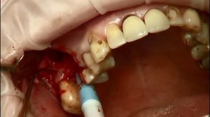 Открытый синус-лифтинг. Операция. Коллагеновый матр