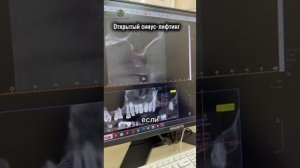Открытый синус-лифтинг