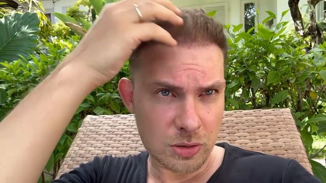 4 МЕСЯЦА ПОСЛЕ ПЕРЕСАДКИ ВОЛОС: ПРОГРЕСС И ОЖИДАНИЯ смотреть онлайн