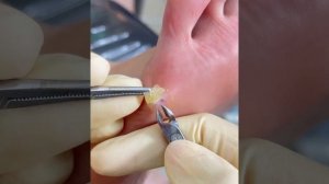 Удаление стержневой мозоли