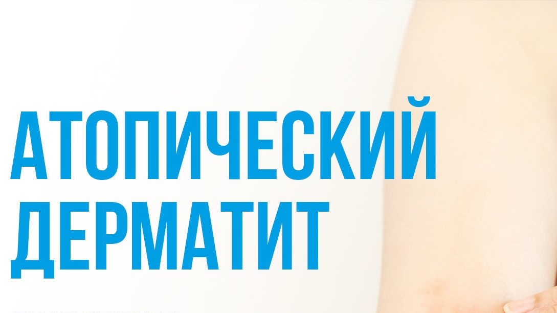 ПОСЛЕ ТЕРАПИИ ПРОШЁЛ АТОПИЧЕСКИЙ ДЕРМАТИТ