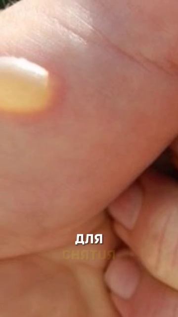 Лечение ожога от борщевика #shorts смотреть онлайн