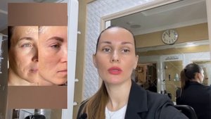 Процедура Flaxlift, омоложение без уколов