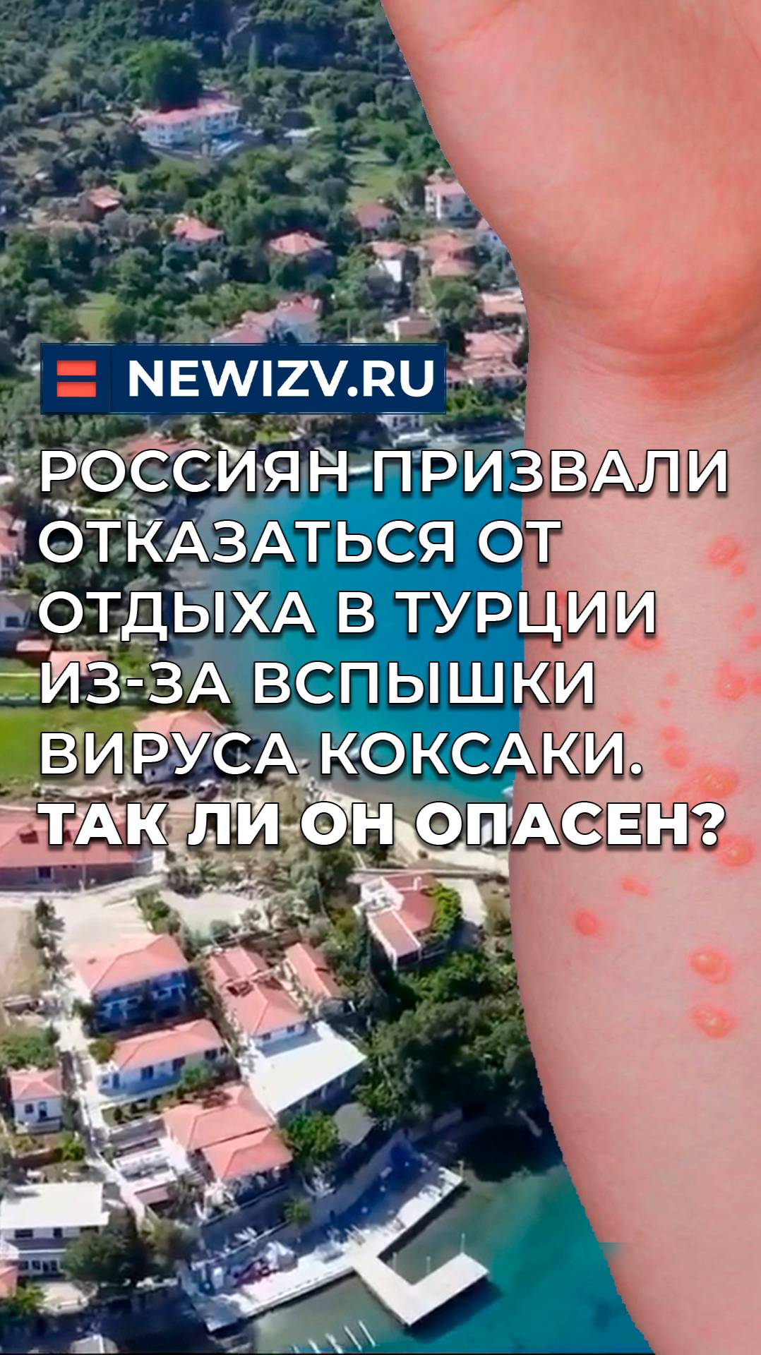 Россиян призвали отказаться от отдыха в Турции из-за вспышки вируса Коксаки. Так ли он опасен?