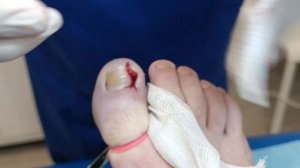 Вросший ноготь - операция краевая резекция после безу?