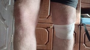 Ручка лейки.18 день после травмы,сделали укол Дипромет?